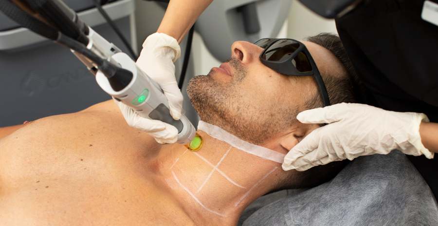 A Comprehensive Guide to Laser Hair Removal Birmingham