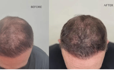 Amazing Results: Scalp Micropigmentation (SMP) Before and After in Birmingham, UK