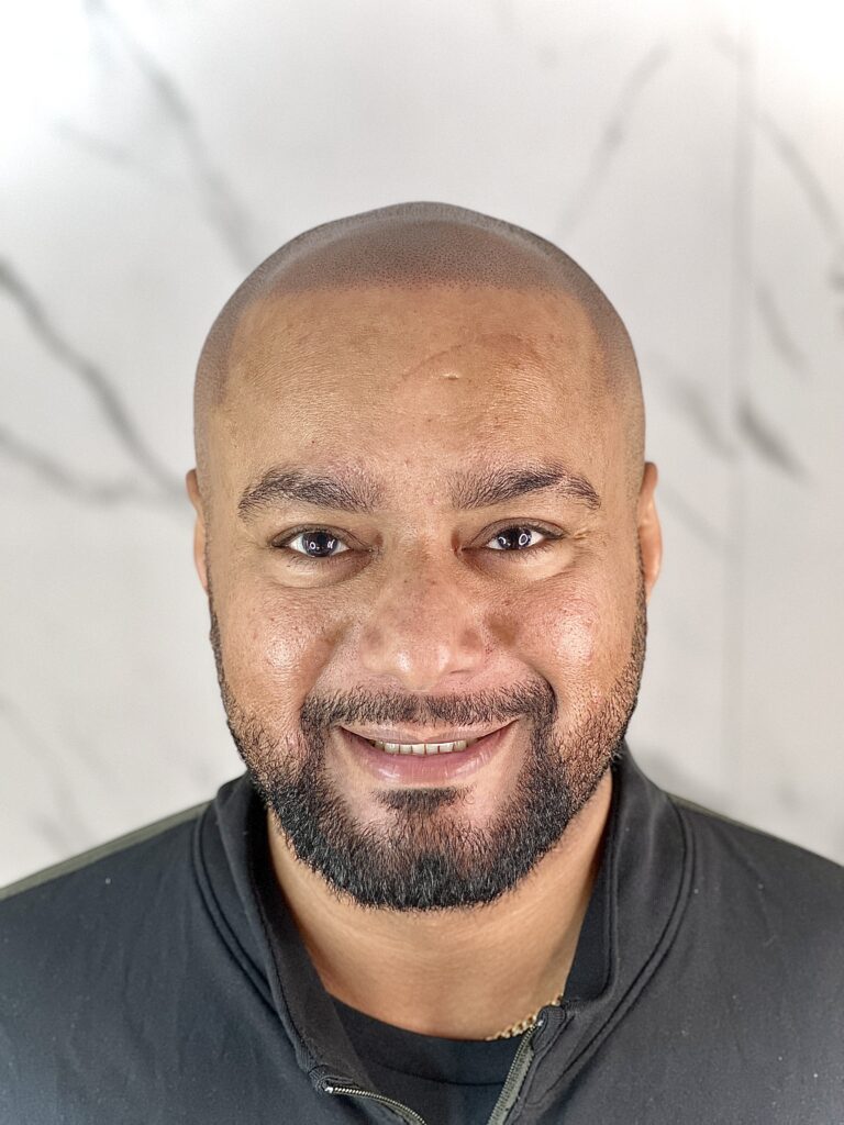 Hair line tattoo Birmingham