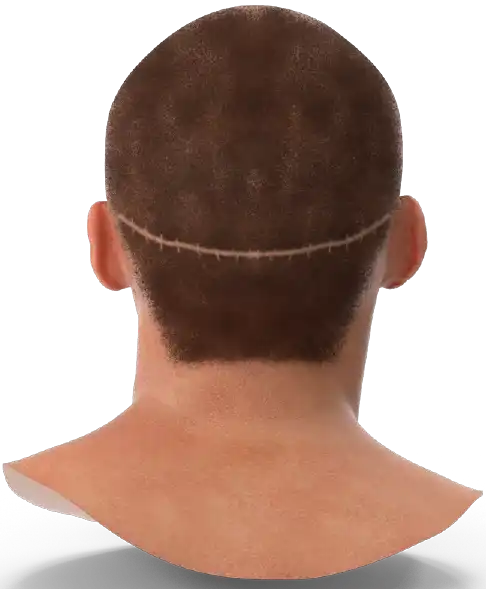 SMP for Scars Birmingham